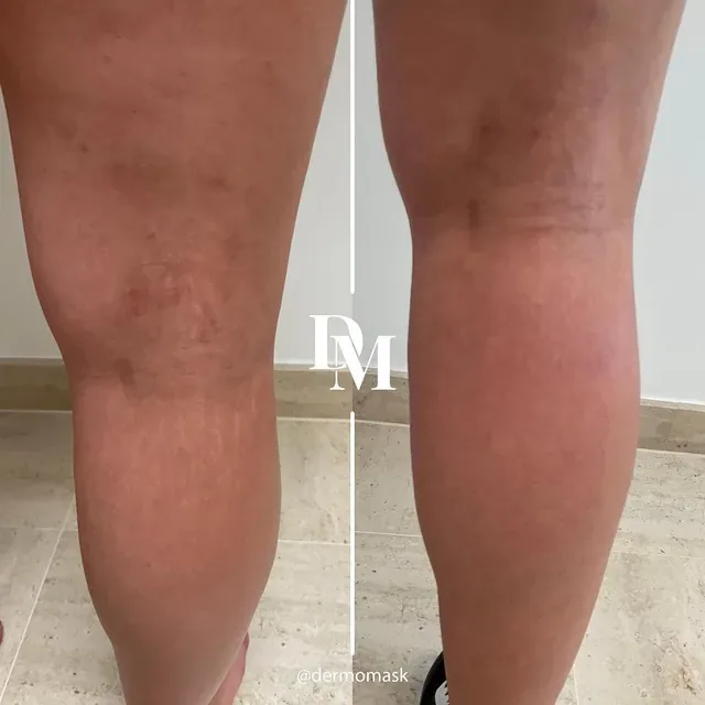 Arrière des jambes avec des vergetures, avant et après traitement